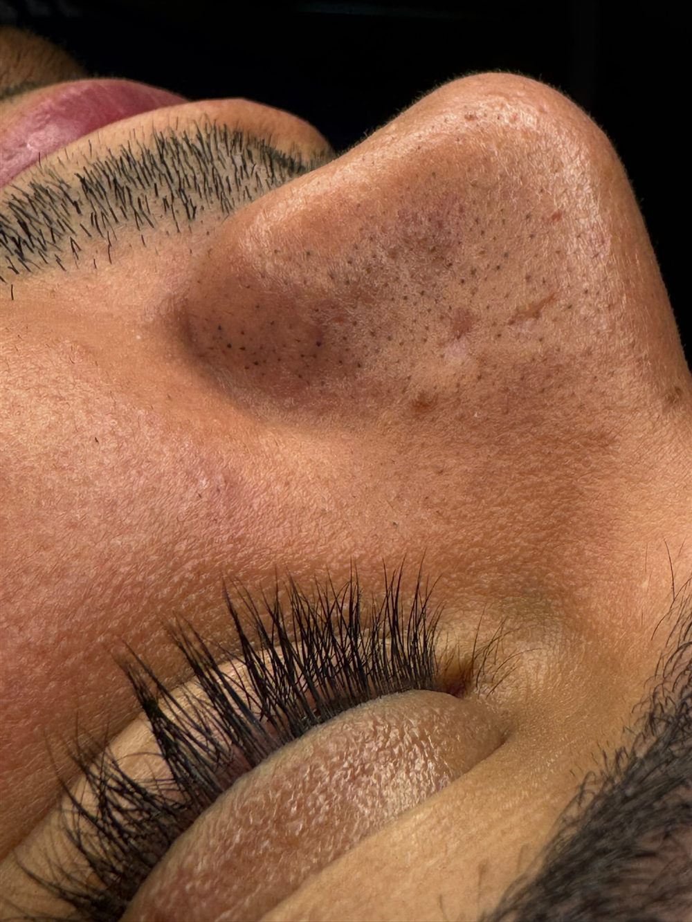 Deep Facial Cleansing with HydraFacial