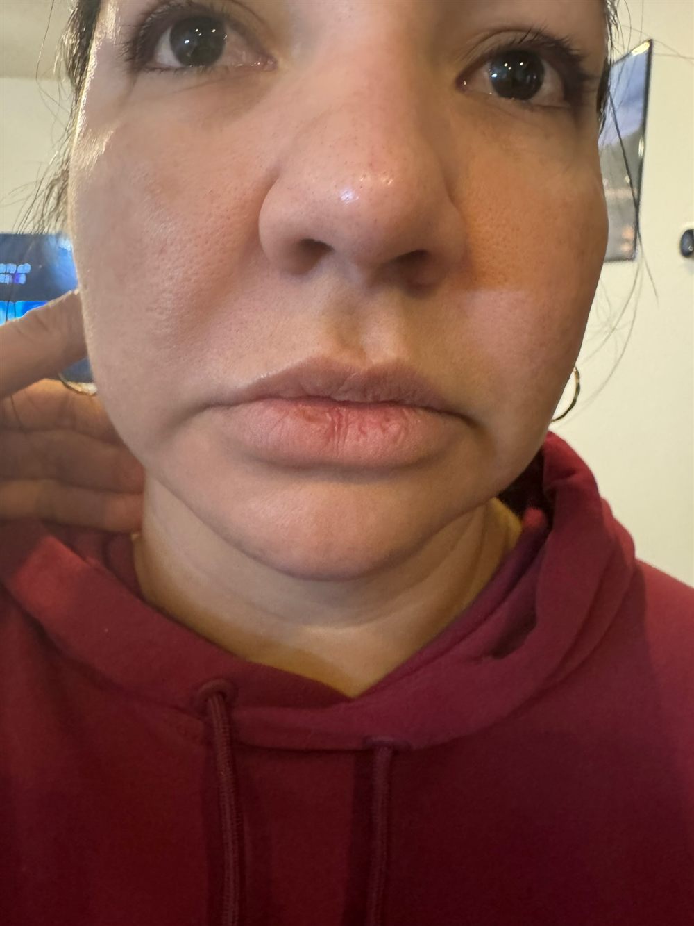 PRP + Dermapen