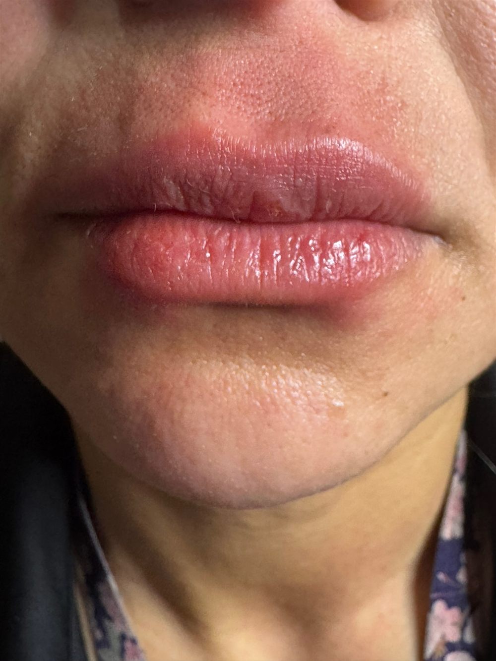 Facial Fillers – Starting at $650/syringe