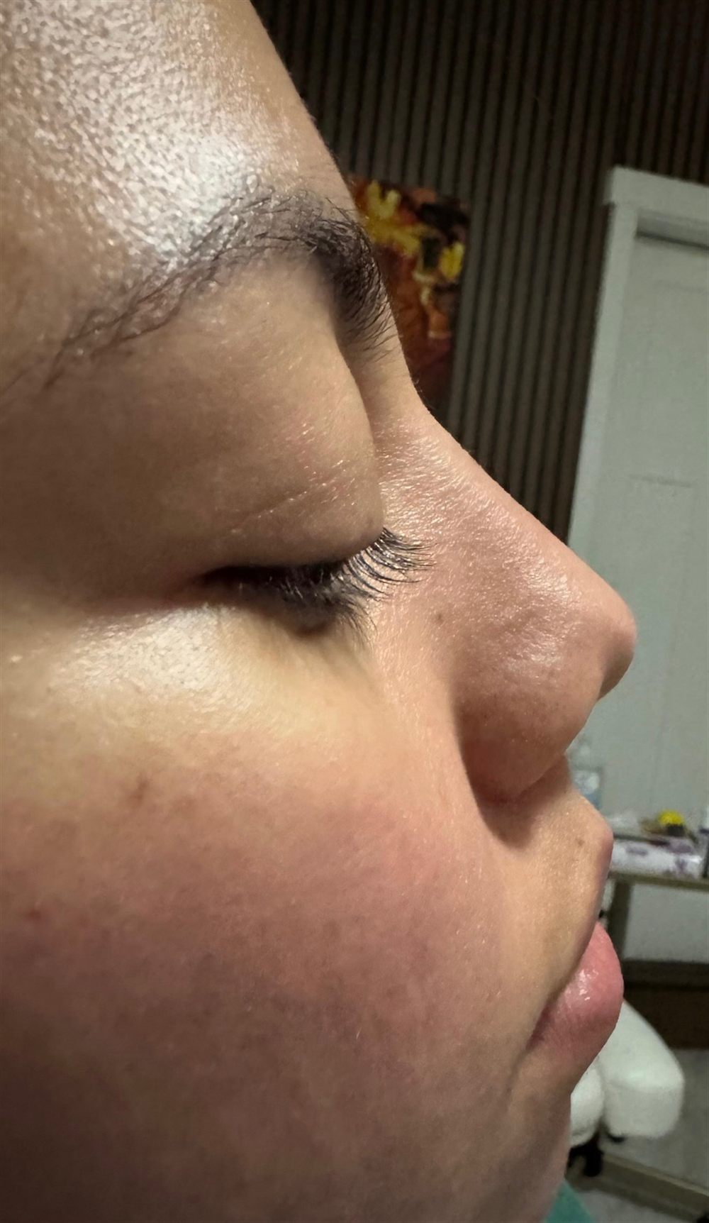 Enlarged Pores (Nose) with Laser
