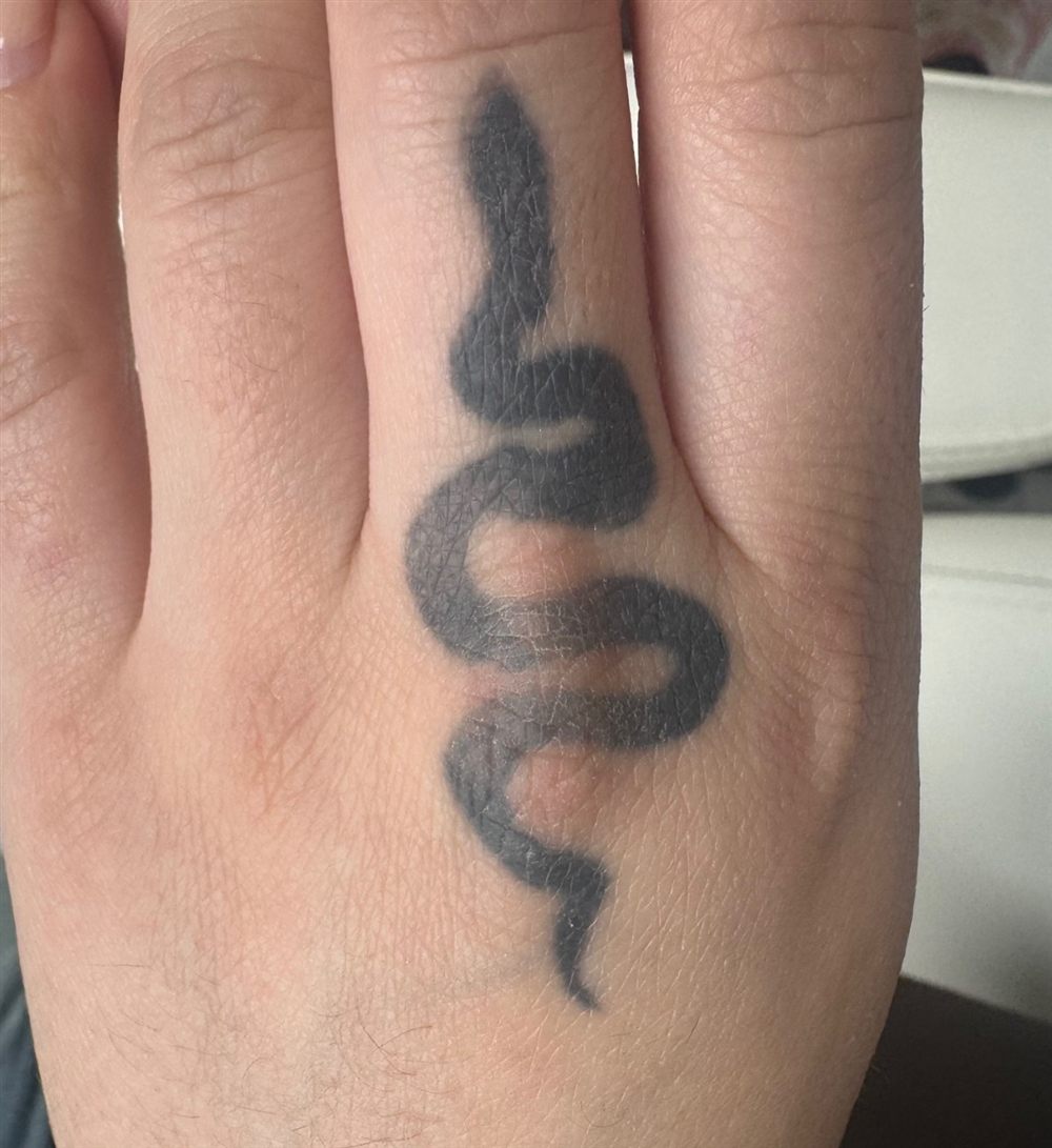 Laser Tattoo Removal